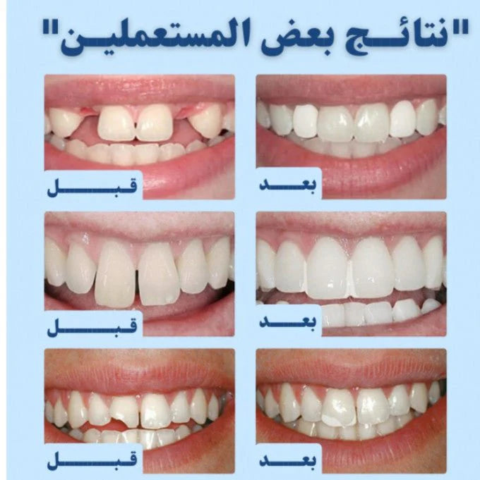 حبيبات إصلاح الأسنان Smile Renew